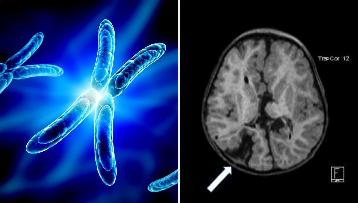 Esta imagen axial T1 ponderada de una niña de 2 años de edad con síndrome de Aicardi muestra esquizencefalia de labio cerrado de lóbulo parietal derecho (flecha), polimicrogiria, heterotopía de la materia gris del lado izquierdo y agenesia del cuerpo calloso Esta imagen axial T1 ponderada de una niña de 2 años de edad con síndrome de Aicardi muestra esquizencefalia de labio cerrado de lóbulo parietal derecho (flecha), polimicrogiria, heterotopía de la materia gris del lado izquierdo y agenesia del cuerpo calloso