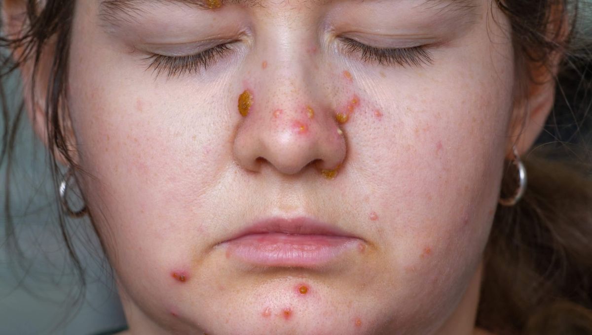 ¿Por qué siempre salen granos en la nariz?