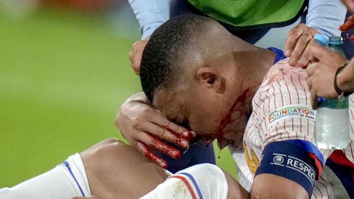Afortunadamente para Kylian Mbappé y para la Selección de Francia, su fractura no necesita cirugía y su retornó a la Eurocopa sería posible.