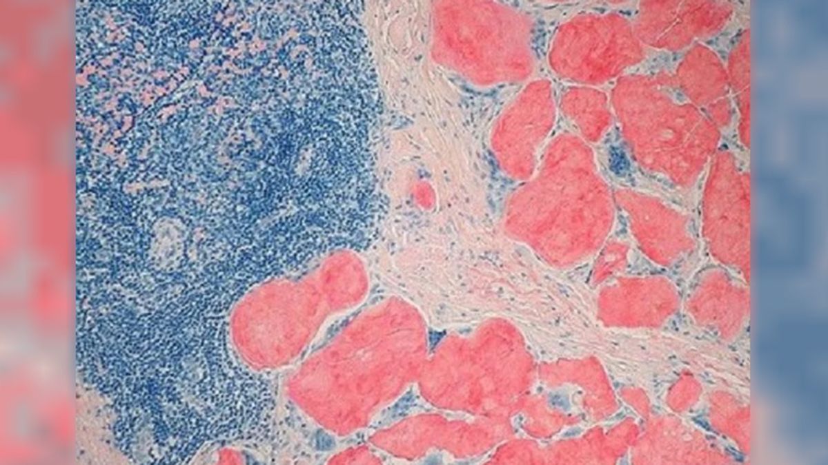 Amiloidosis Hereditaria por Transtiretina: una enfermedad rara que afecta a unas 50 mil personas en el mundo