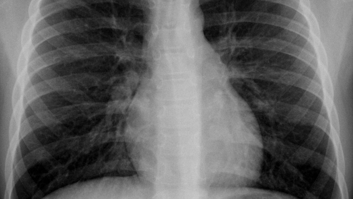 A la mujer le encontraron un preservativo en el pulmón. Foto ilustrativa.&nbsp;