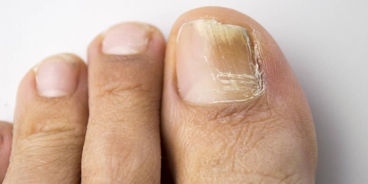 Dile adiós a las uñas amarillas: la rutina que debes seguir para que estén lindas y saludables Dile adiós a las uñas amarillas: la rutina que debes seguir para que estén lindas y saludables