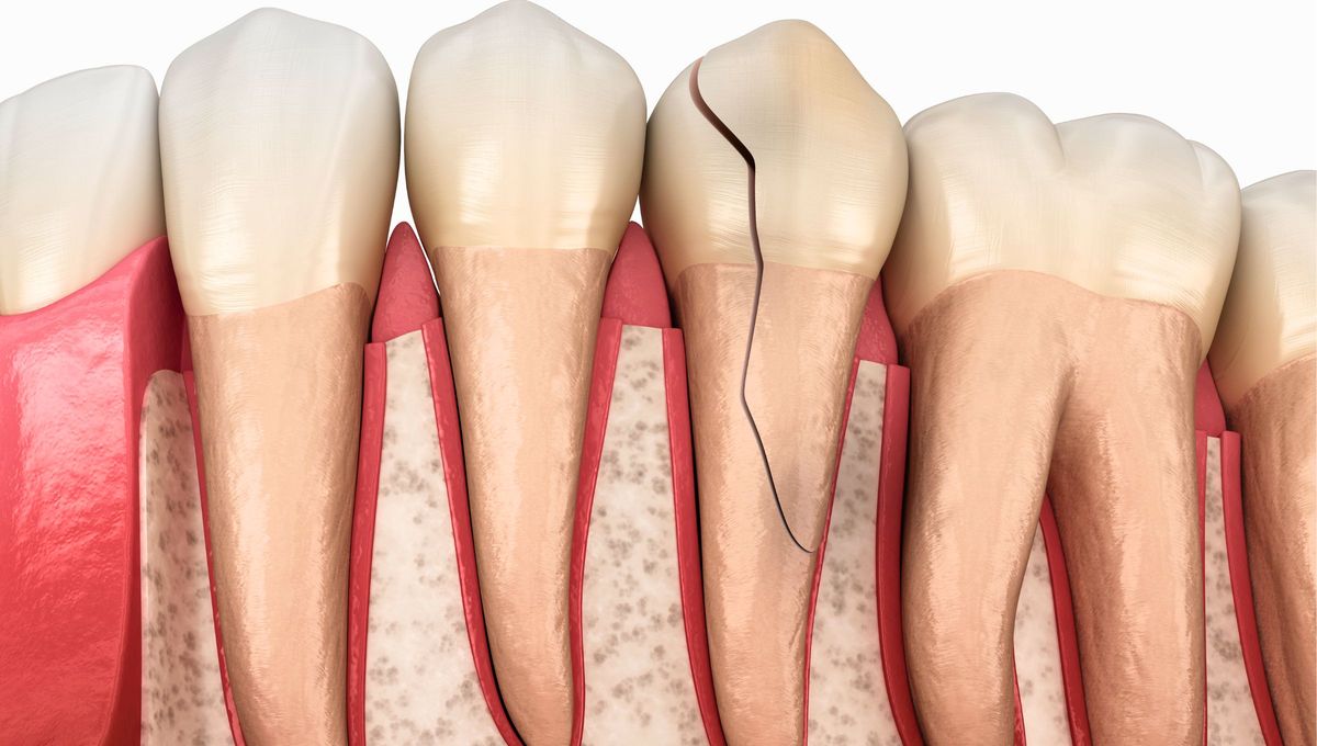 El esmalte dental es la sustancia más dura del cuerpo, incluso más resistente que los huesos. El esmalte dental es la sustancia más dura del cuerpo, incluso más resistente que los huesos.