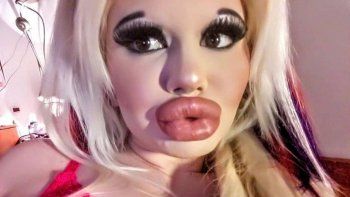 La Barbie Humana se operó los labios 15 veces y va por más