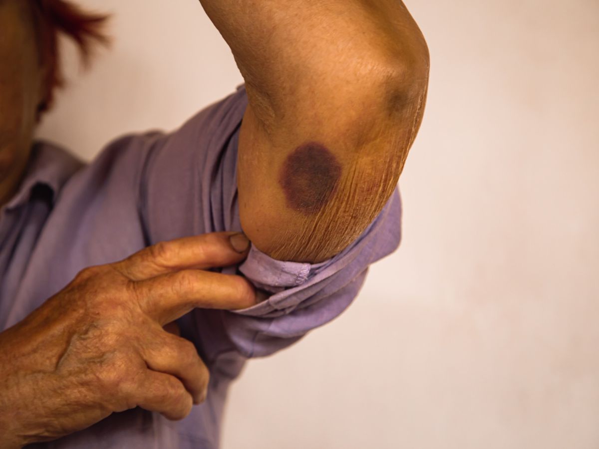 Moretones sin golpes en adultos mayores: por qué se producen y cómo eliminarlos Moretones sin golpes en adultos mayores: por qué se producen y cómo eliminarlos