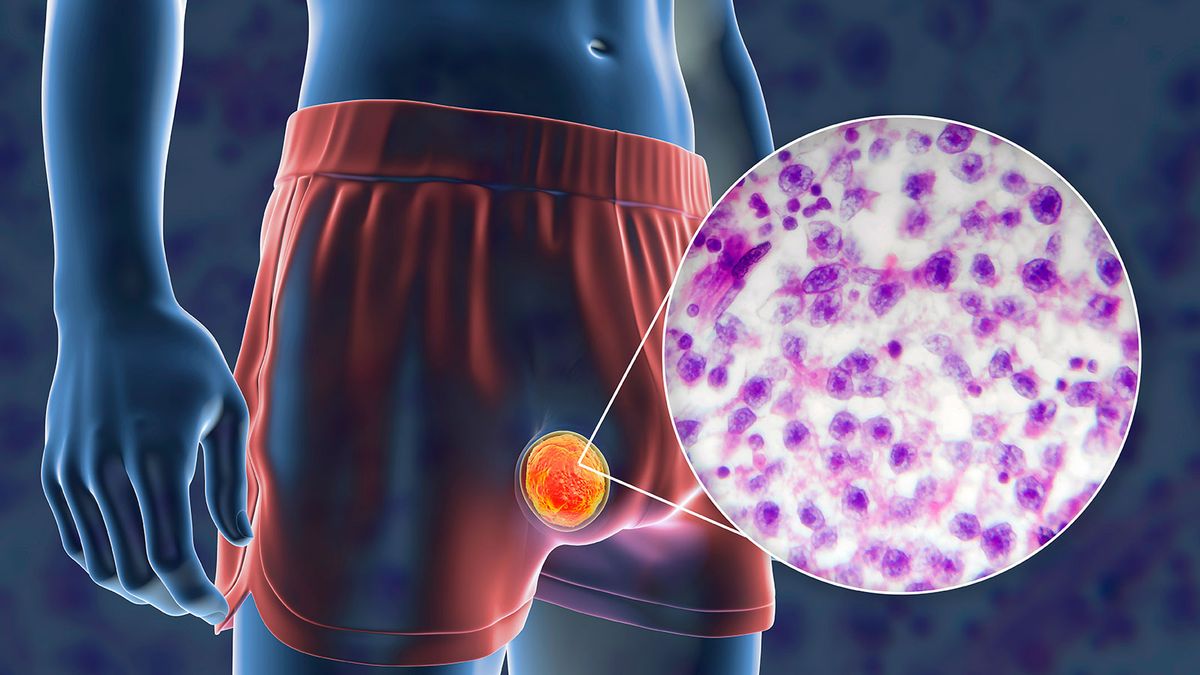 Cáncer testicular: principales síntomas y causas según la medicina Cáncer testicular: principales síntomas y causas según la medicina