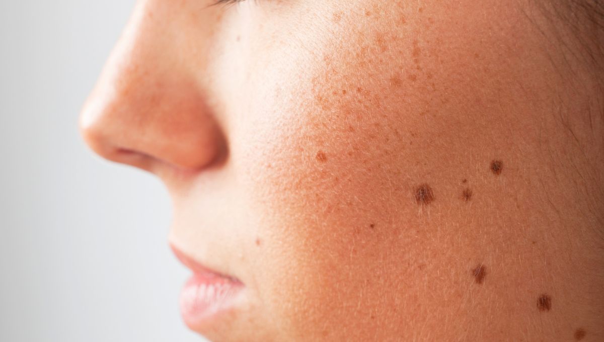 La mayor&iacute;a de las personas tienen lunares, al igual que manchas de nacimiento.