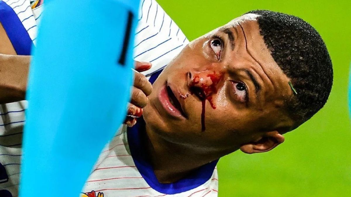 La fractura de nariz de Kylian Mbappé podría dejar a su principal figura&nbsp; fuera del resto de la Eurocopa 2024.