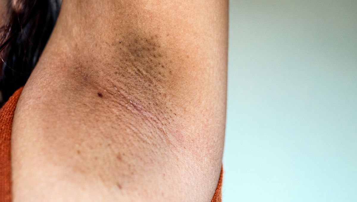 Axilas negras Axilas negras