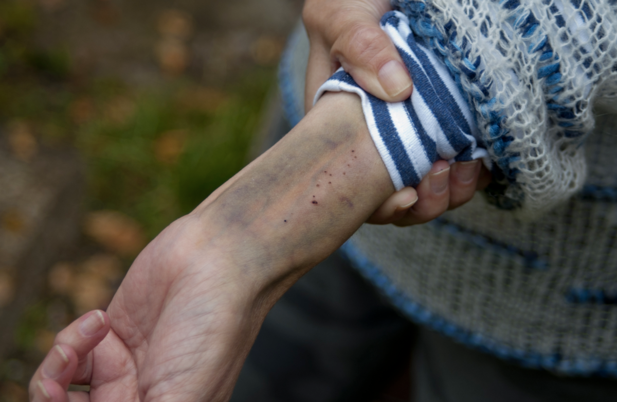 Moretones sin golpes en adultos mayores: por qué se producen y cómo eliminarlos Moretones sin golpes en adultos mayores: por qué se producen y cómo eliminarlos