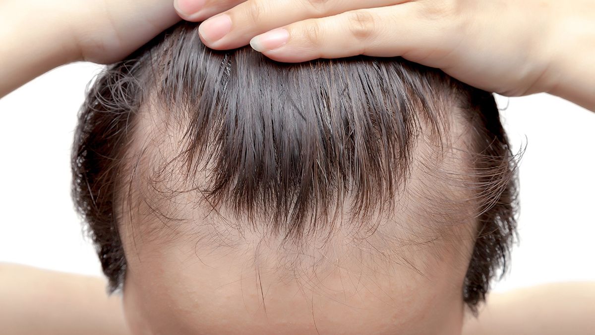 El 98% de los casos de caída capilar en hombres es por causa hereditaria.