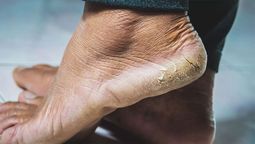 Los talones se pueden limpiar con un método que no todos conocen y arroja buenos resultados. Los talones se pueden limpiar con un método que no todos conocen y arroja buenos resultados.