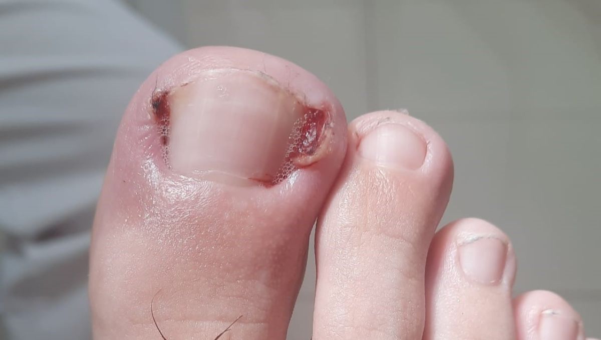 Las uñas siempre deben cortarse con forma cuadrada y no redonda. Las uñas siempre deben cortarse con forma cuadrada y no redonda. 