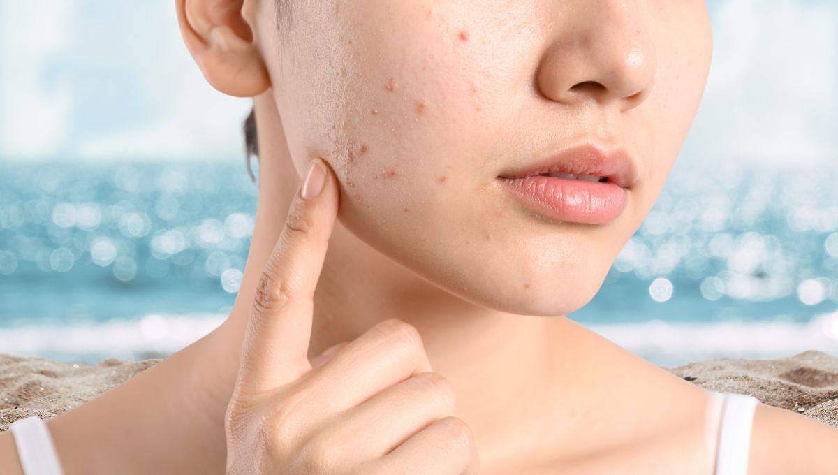 Por qué durante el verano nuestra piel se llena de más granitos