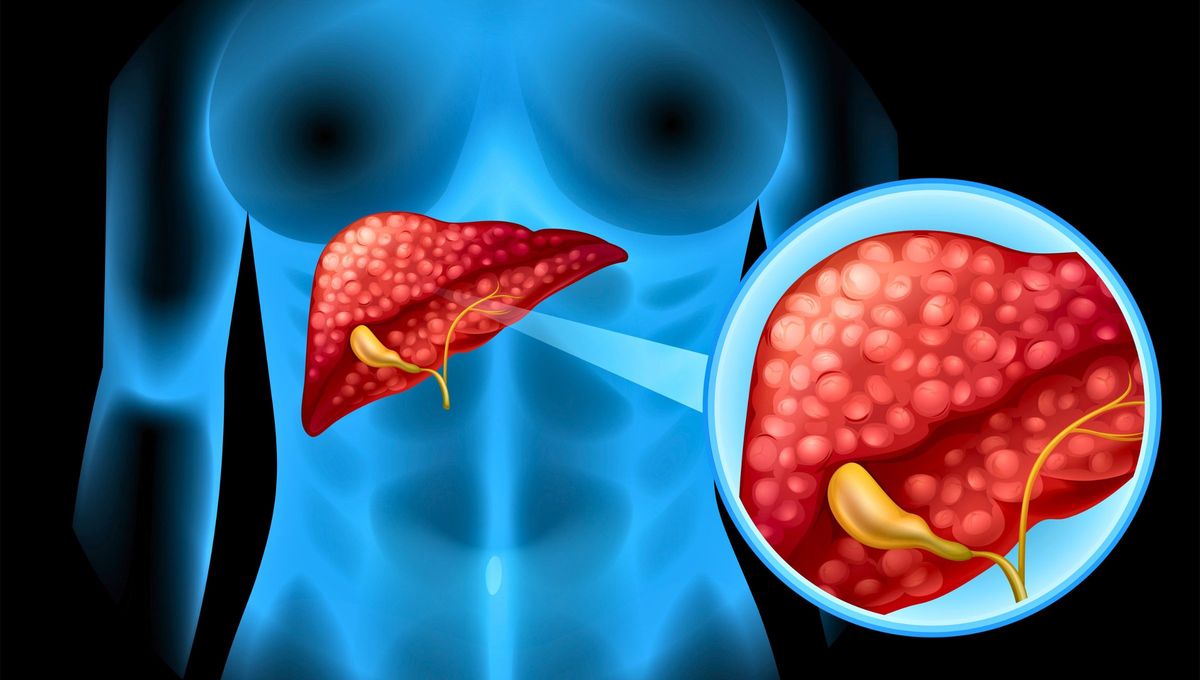 El hígado graso se puede combatir con una dieta equilibrada y actividad física de forma regular, según los expertos. 