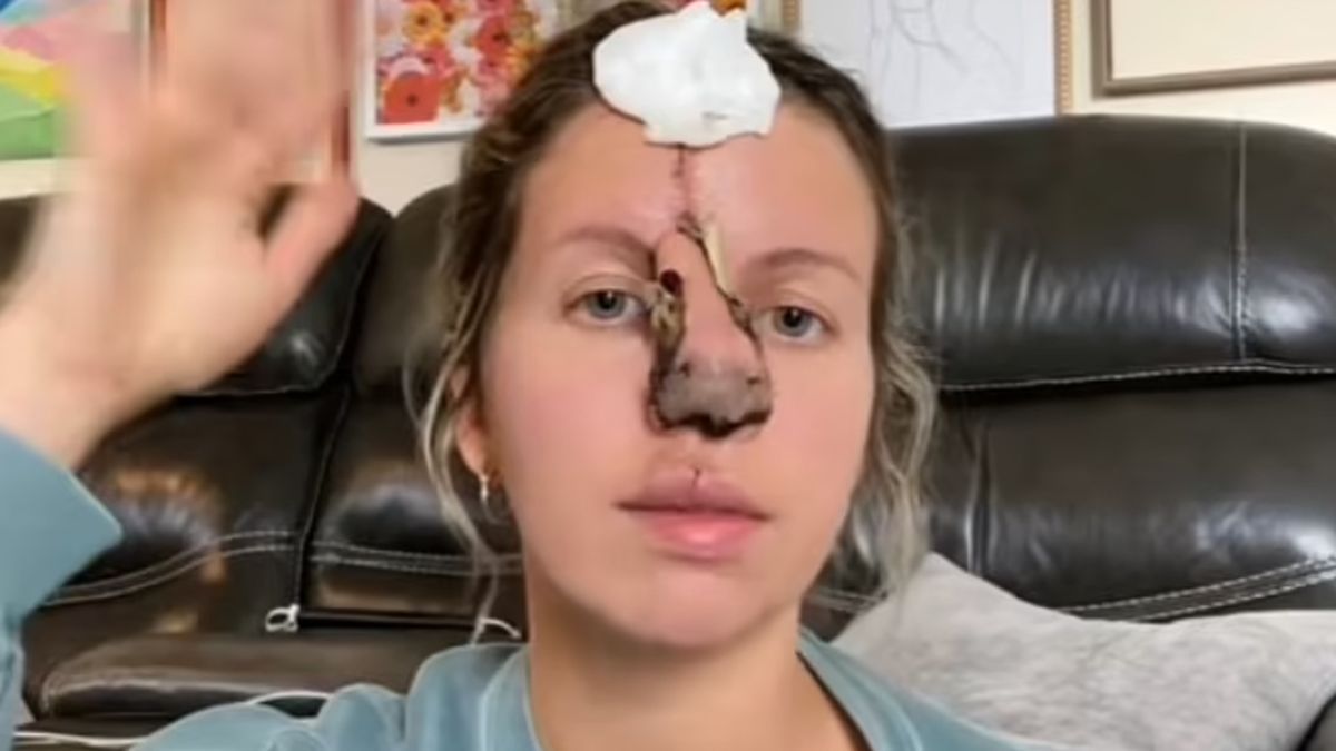 Shayna está recibiendo complicadas operaciones de colgas en la frente para recuperar su nariz. Shayna está recibiendo complicadas operaciones de colgas en la frente para recuperar su nariz.