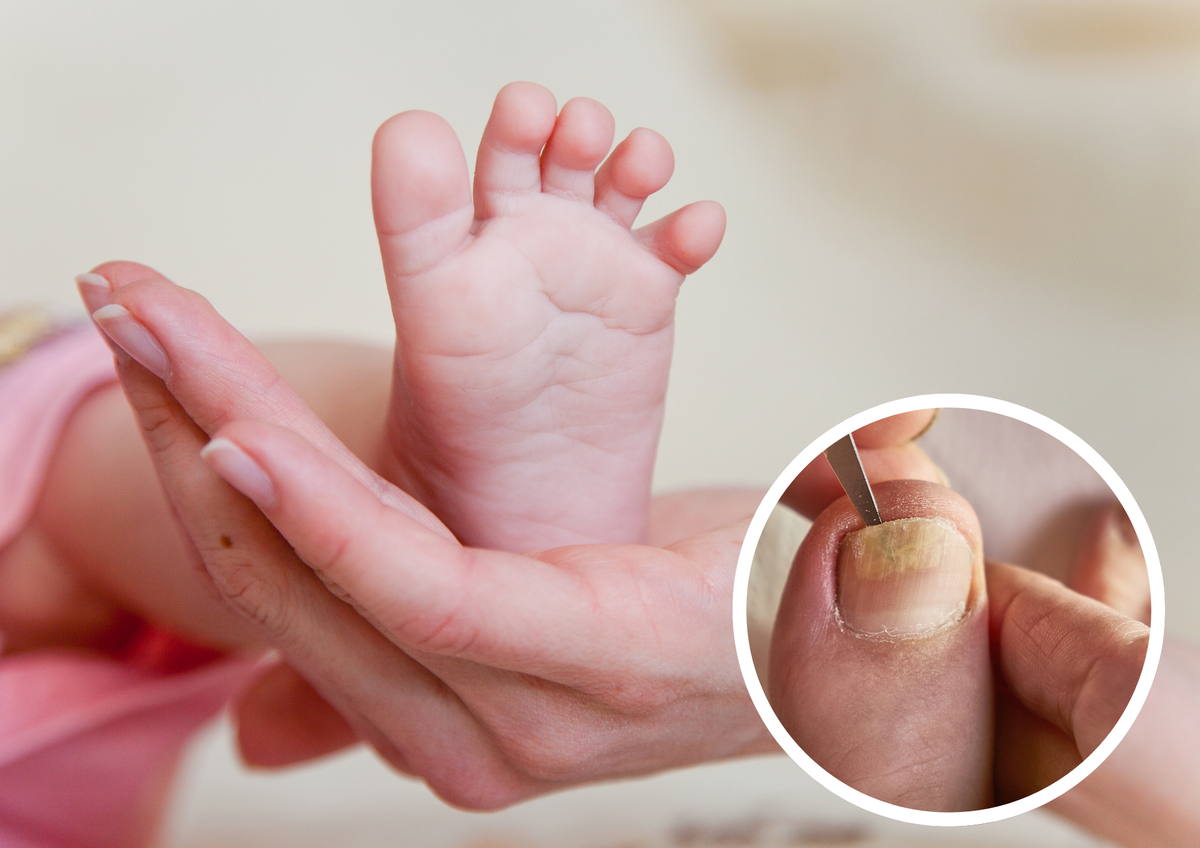 Los hongos en las uñas de los pies pueden resultar molestos y dolorosos para nuestros hijos 