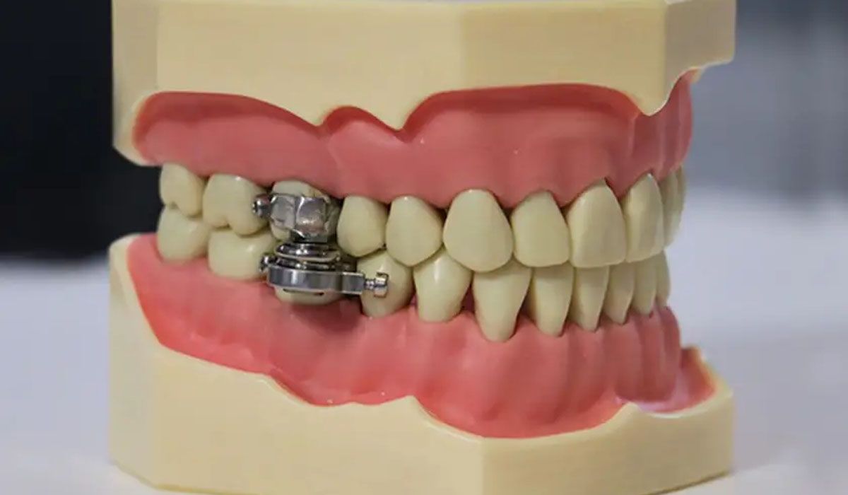 El dispositivo para adelgazar que te 