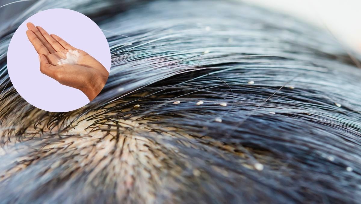Cómo eliminar a los piojos de la cabeza usando un poco de acondicionador: extracción casera y efectiva