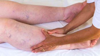Adultos mayores: el sencillo ejercicio que previene las várices y mejora la circulación