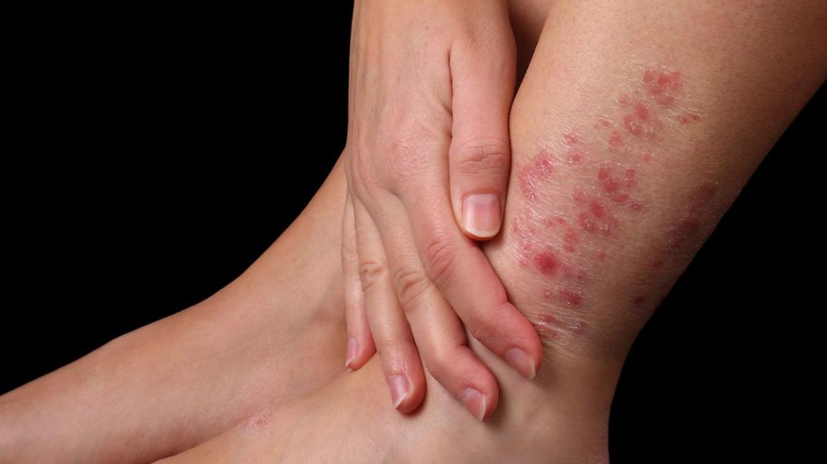 Un medicamento para tratar la psoriasis podría ser eficaz en pacientes con lupus eritematoso sistémico Un medicamento para tratar la psoriasis podría ser eficaz en pacientes con lupus eritematoso sistémico