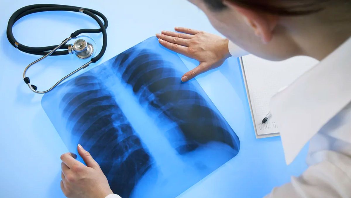 Ni neumonía, ni tuberculosis: la mujer que tosió 6 meses por algo insólito en su pulmón