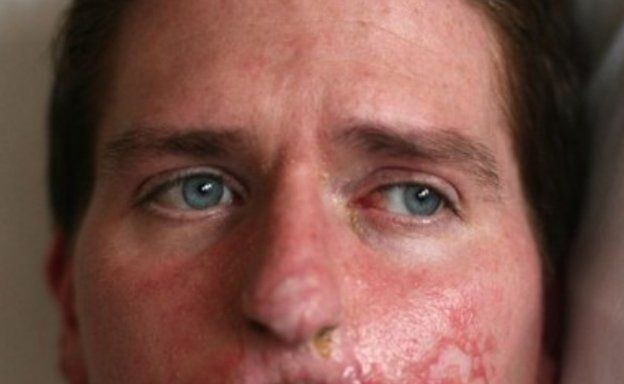 El caso de la bacteria carnívora que devora poco a poco a un padre de familia