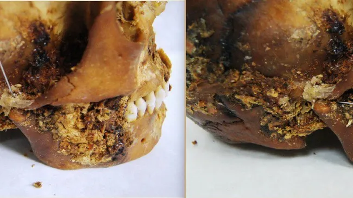 Descubrimiento sorprende a la medicina: la cirugía compleja de 2500 años
