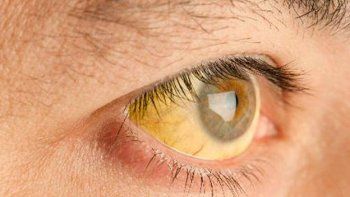 La hepatitis mata casi tanto como el sida, según la OMS