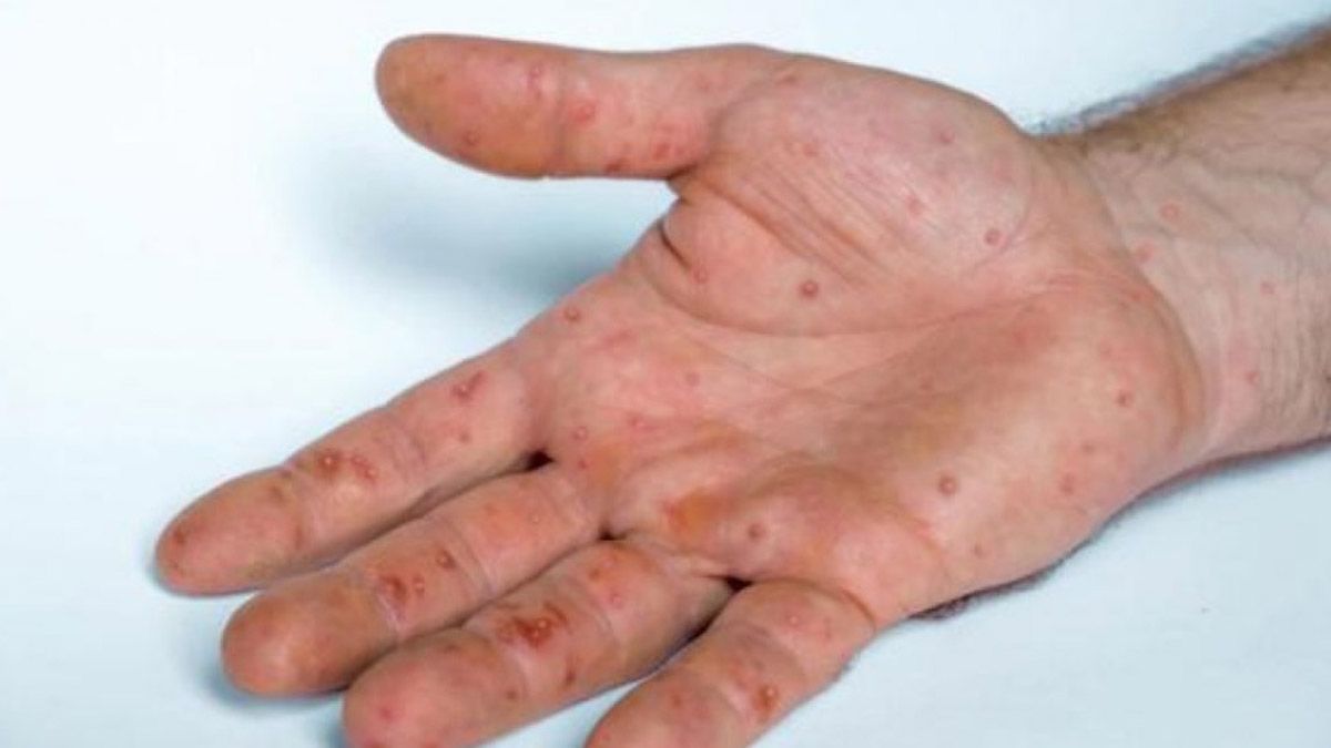 Los síntomas son presencia de exantemas (erupciones en la piel) vesiculares en diferentes localizaciones incluyendo genitales, perianales, manos, torso y cara, fiebre y linfoadenopatías.