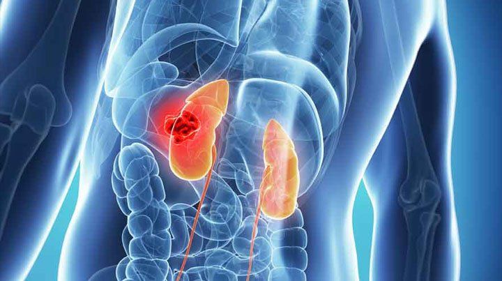 El Síndrome Urémico Hemolítico es la segunda causa de trasplante renal en niños. El Síndrome Urémico Hemolítico es la segunda causa de trasplante renal en niños.