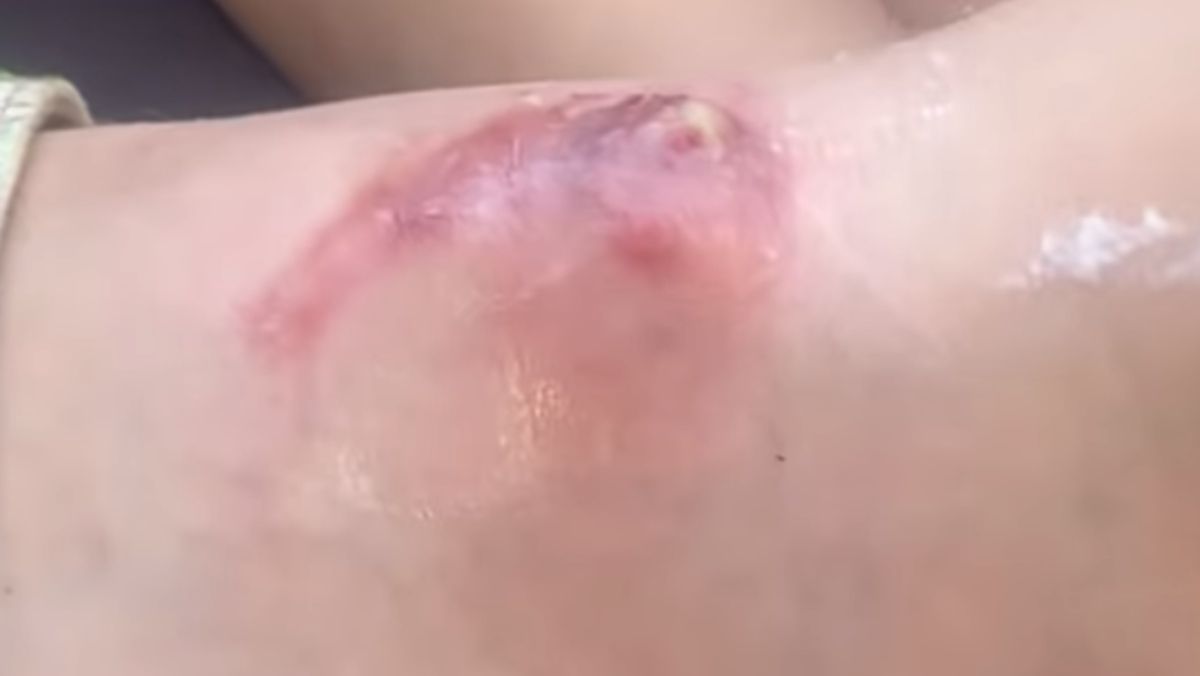 Captura de imagen del video que compartió la mamá de Juanita y que muestra las úlceras que se formaron en la piel de la nena lasherina. Captura de imagen del video que compartió la mamá de Juanita y que muestra las úlceras que se formaron en la piel de la nena lasherina.