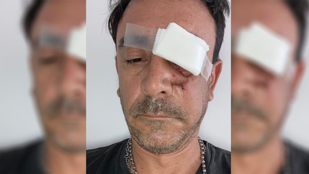 Hernán Clut, de 46 años, sufrió hundimiento y fractura de pómulo, y maxilar, además de haber perdido la sensibilidad en la mitad de su rostro.