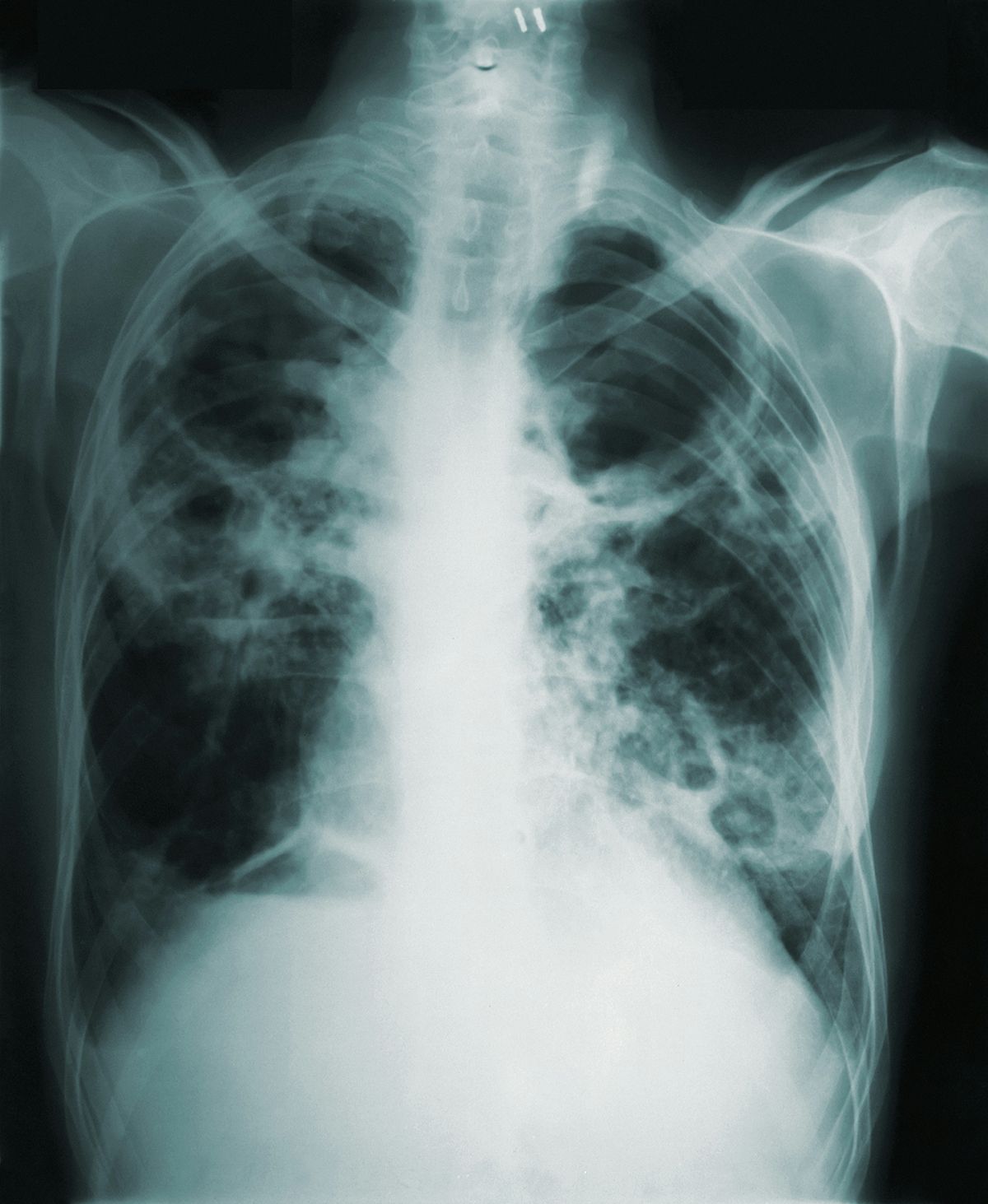 La tuberculosis activa se manifiesta a través de síntomas como tos prolongada, fiebre y pérdida de peso, y puede ser contagiosa. Este brote es el más grande de la historia de Estados Unidos. La tuberculosis activa se manifiesta a través de síntomas como tos prolongada, fiebre y pérdida de peso, y puede ser contagiosa. Este brote es el más grande de la historia de Estados Unidos.