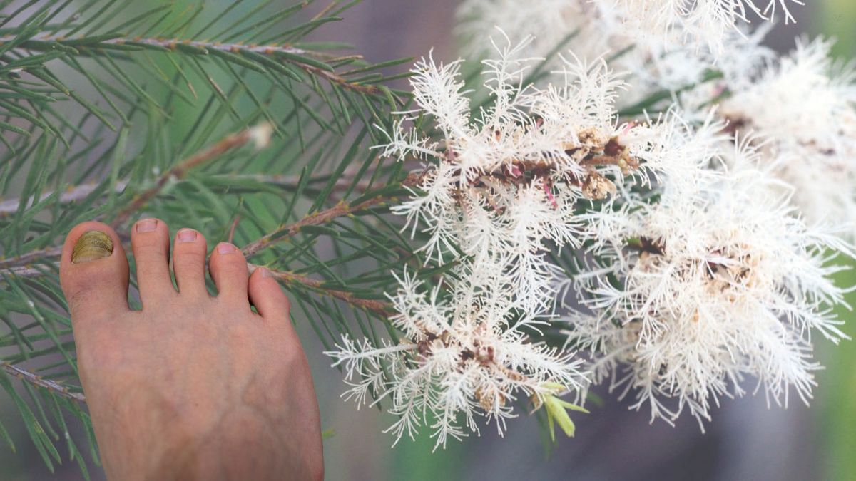 Árbol de té: cómo sembrarlo y cómo usarlo para eliminar los hongos de las uñas