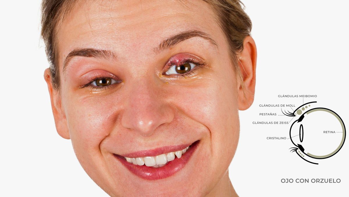 La única forma de prevenir un orzuelo es evitando las causas que puedan provocar una infección en la zona palpebral del ojo La única forma de prevenir un orzuelo es evitando las causas que puedan provocar una infección en la zona palpebral del ojo