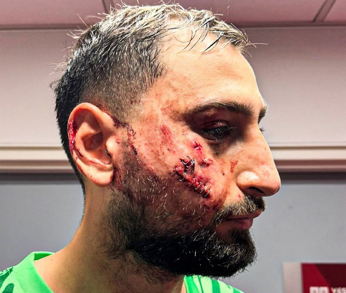 Así quedó el rostro de Gianluigi Donnarumma. Así quedó el rostro de Gianluigi Donnarumma.