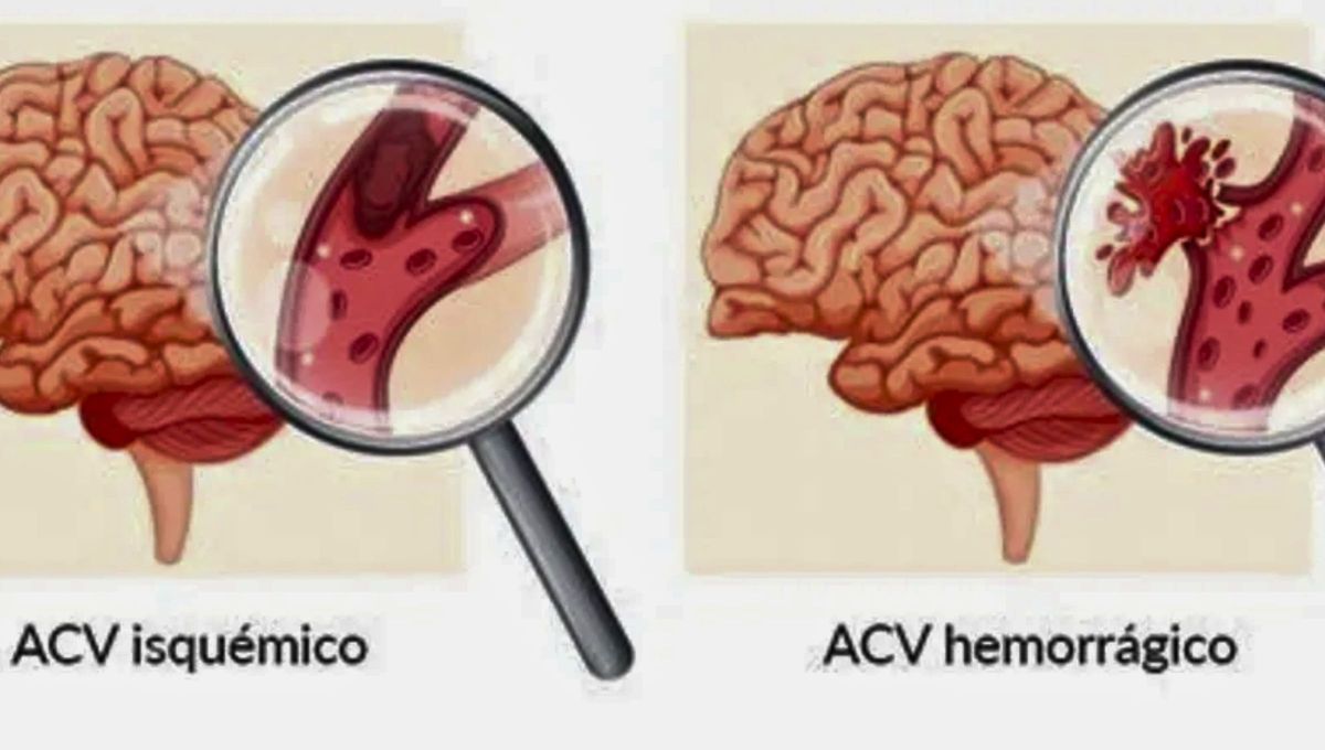 Un ACV ocurre cuando el flujo de sangre a una parte del cerebro se detiene o disminuye, lo que impide que el tejido cerebral reciba oxígeno y nutrientes. Un ACV ocurre cuando el flujo de sangre a una parte del cerebro se detiene o disminuye, lo que impide que el tejido cerebral reciba oxígeno y nutrientes.