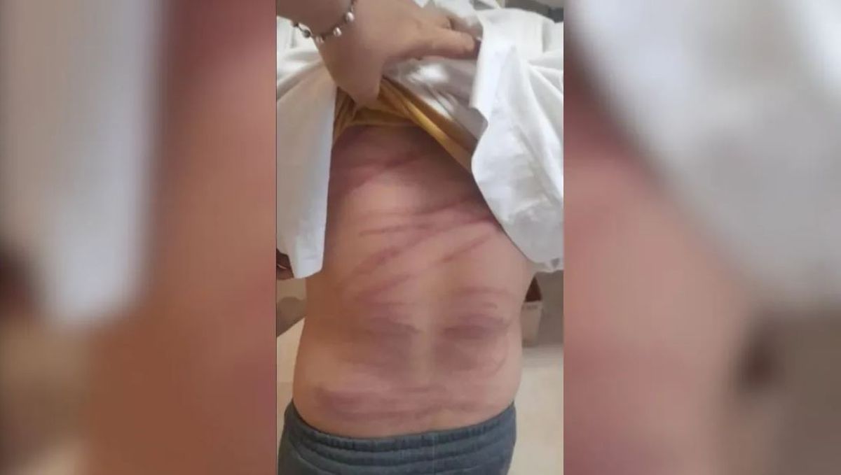 Niño maltratado. Un niño de 10 años fue salvajemente azotado por su madre. Niño maltratado. Un niño de 10 años fue salvajemente azotado por su madre.