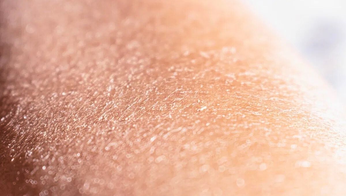 Piel con escamas. Piel con escamas. 