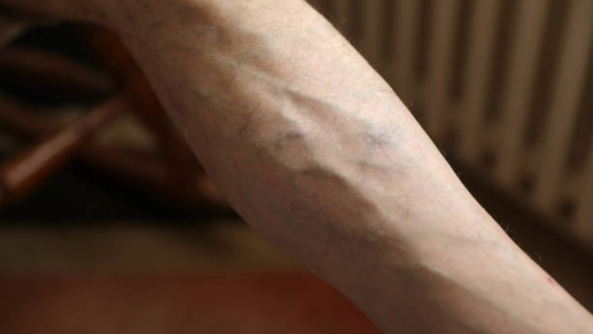 Despídete de las várices gracias a estos ejercicios.