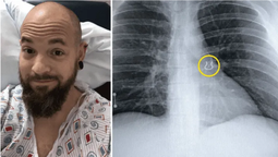 Creyó que tenía coronavirus pero le hallaron algo increíble en los pulmones