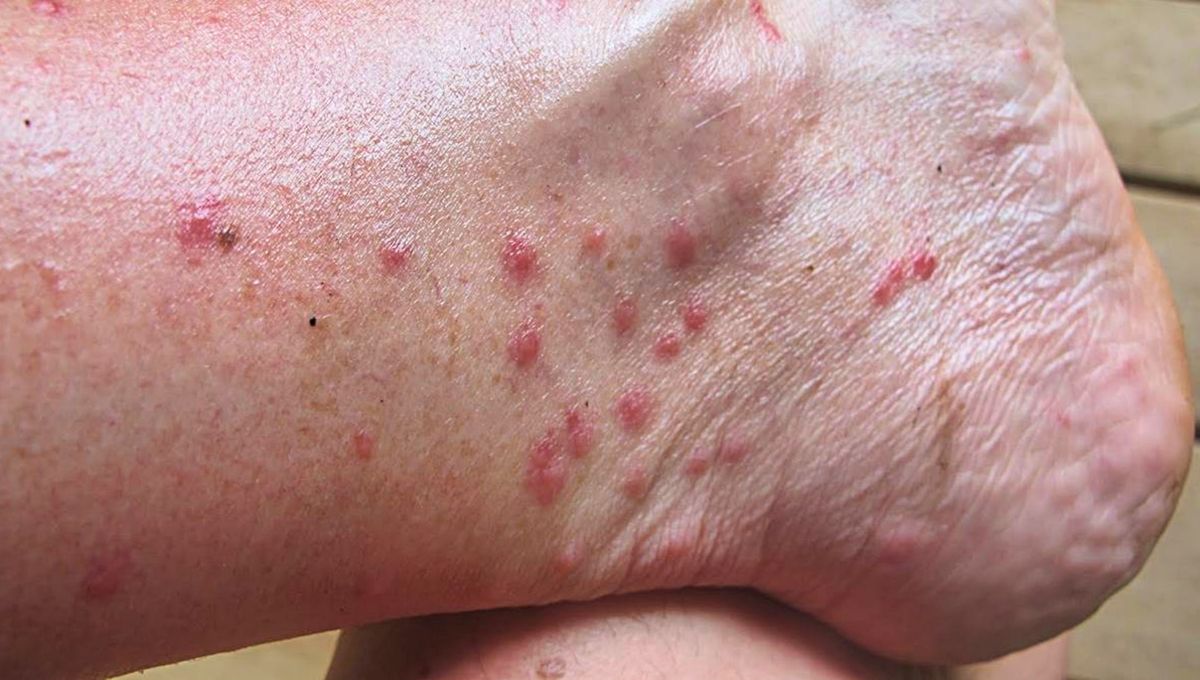 Los mosquitos pican guiados por el olor, el calor y las sustancias de la piel. Los mosquitos pican guiados por el olor, el calor y las sustancias de la piel. 