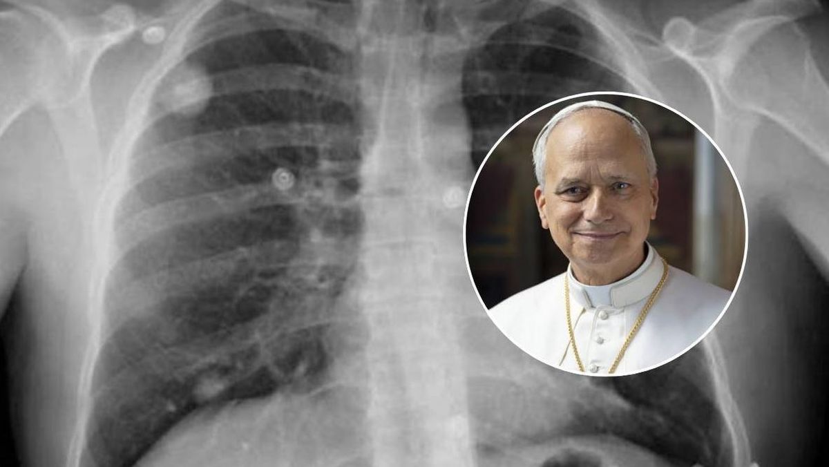 Cáncer de pulmón es lo que le diagnosticaron al papa León XIV. Imagen ilustrativa. 