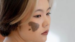 Qué significa tener una mancha de nacimiento en la cara Qué significa tener una mancha de nacimiento en la cara