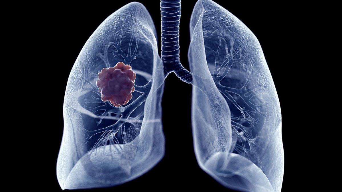 Un nuevo fármaco para el tratamiento del cáncer de pulmón, el amivantamab, ha sido aprobado por la ANMAT y está disponible en Argentina. Un nuevo fármaco para el tratamiento del cáncer de pulmón, el amivantamab, ha sido aprobado por la ANMAT y está disponible en Argentina.