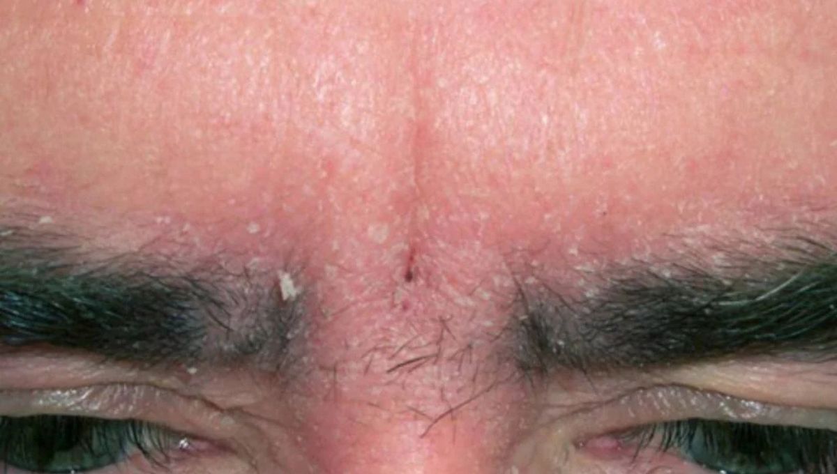 Caspa en la piel. Caspa en la piel.