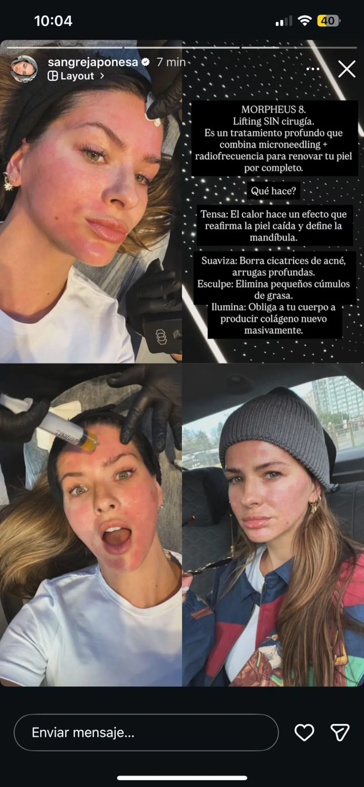 La China Suárez mostró cómo quedó tras su lifting. La China Suárez mostró cómo quedó tras su lifting.