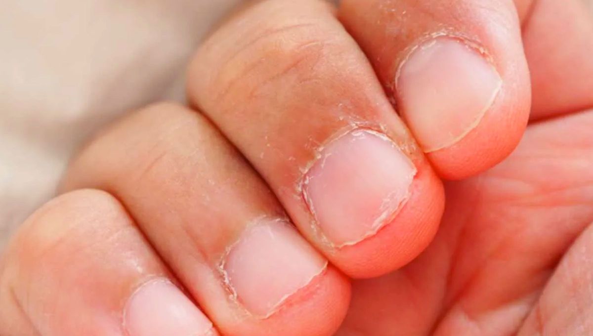 La onicofagia es el hábito de morderse las uñas de los dedos de las manos La onicofagia es el hábito de morderse las uñas de los dedos de las manos