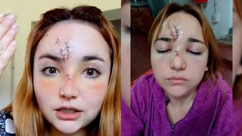La atacaron a botellazos a la salida de un boliche y le desfiguraron la cara